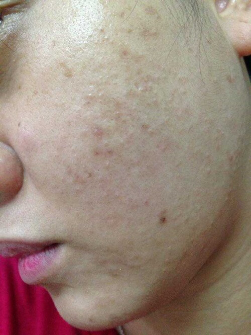 Dấu hiệu sắp có kinh nguyệt- Da dễ nổi mụn